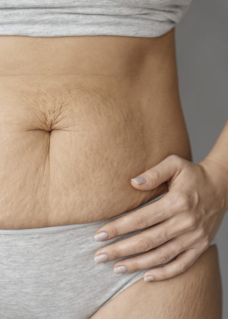 Stretch Marks Treatment