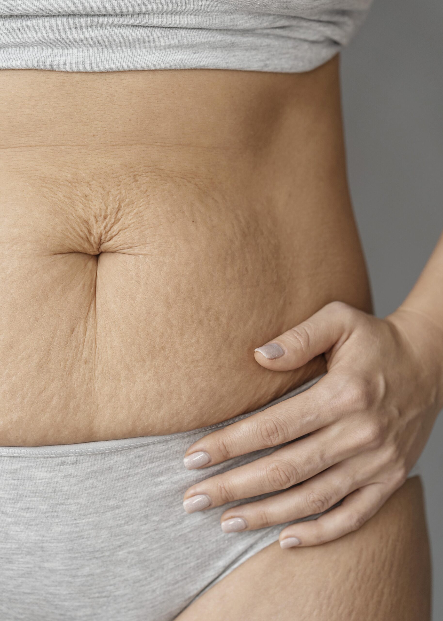 Stretch Marks Treatment